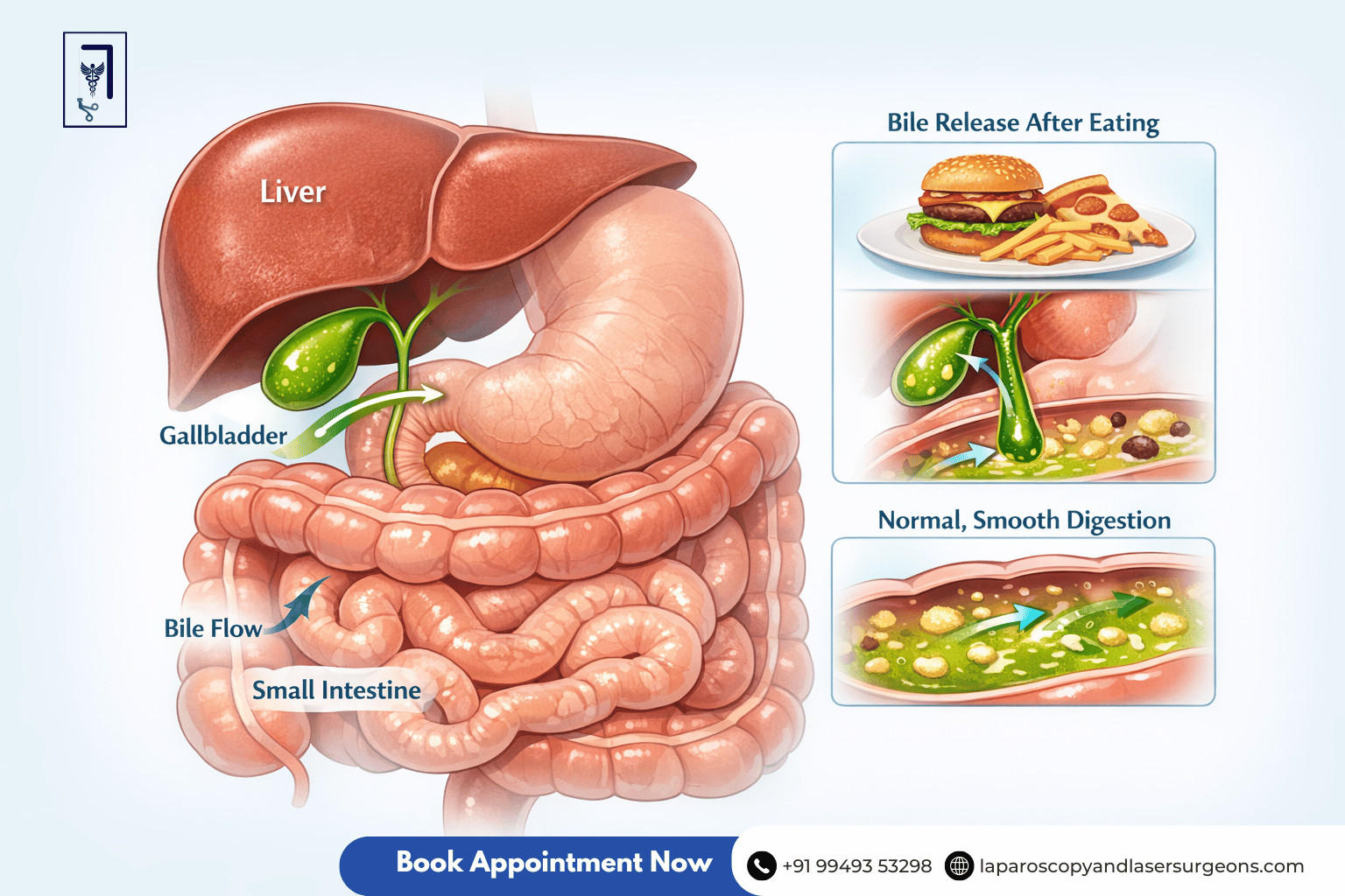 gallbladder stone (11)