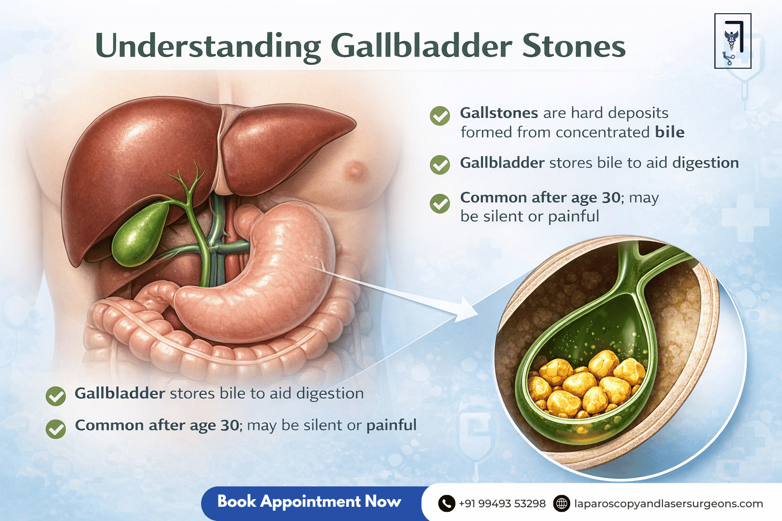 gallbladder stone (4)
