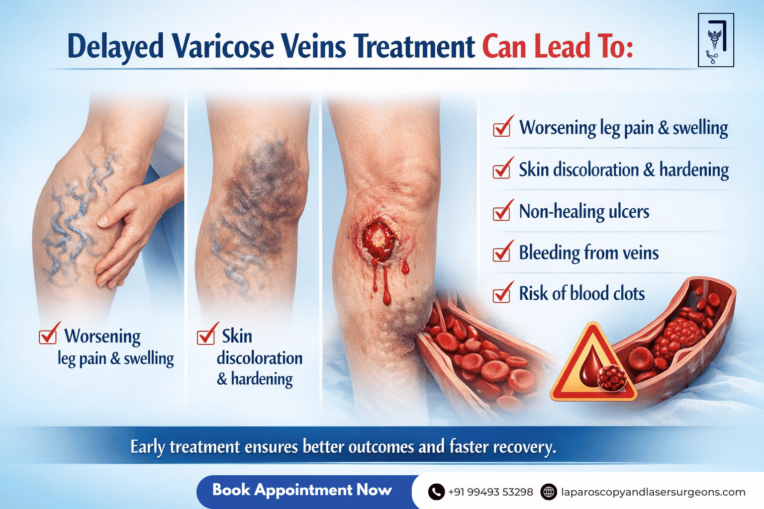 varicose veins (12)